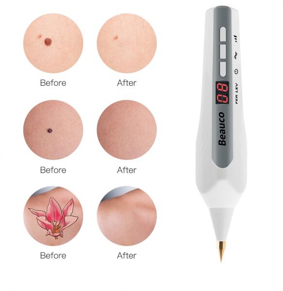 52608 Плазменный коагулятор Beauco (Plasma Pen) SK-215 (WD-0232) Beauty Star  - Вид №3